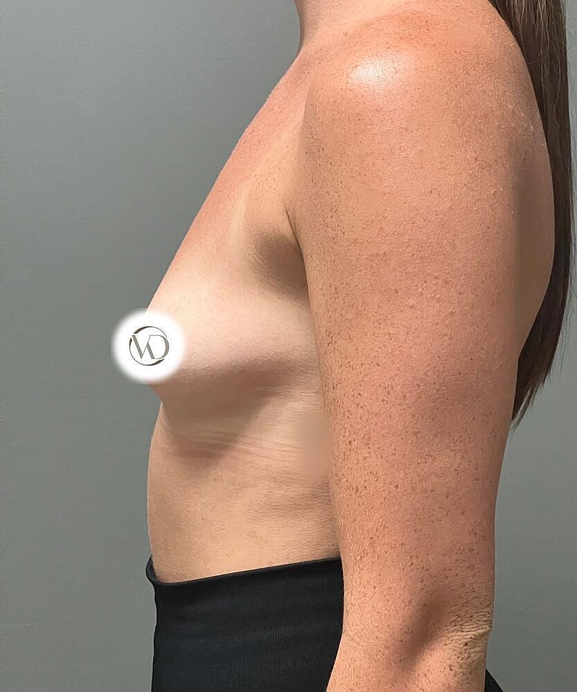 Breast Augmentation Before & After