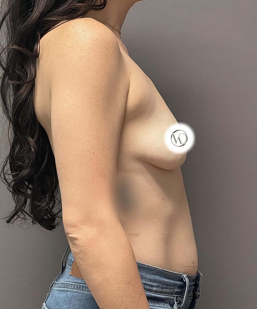 Breast Augmentation Before & After