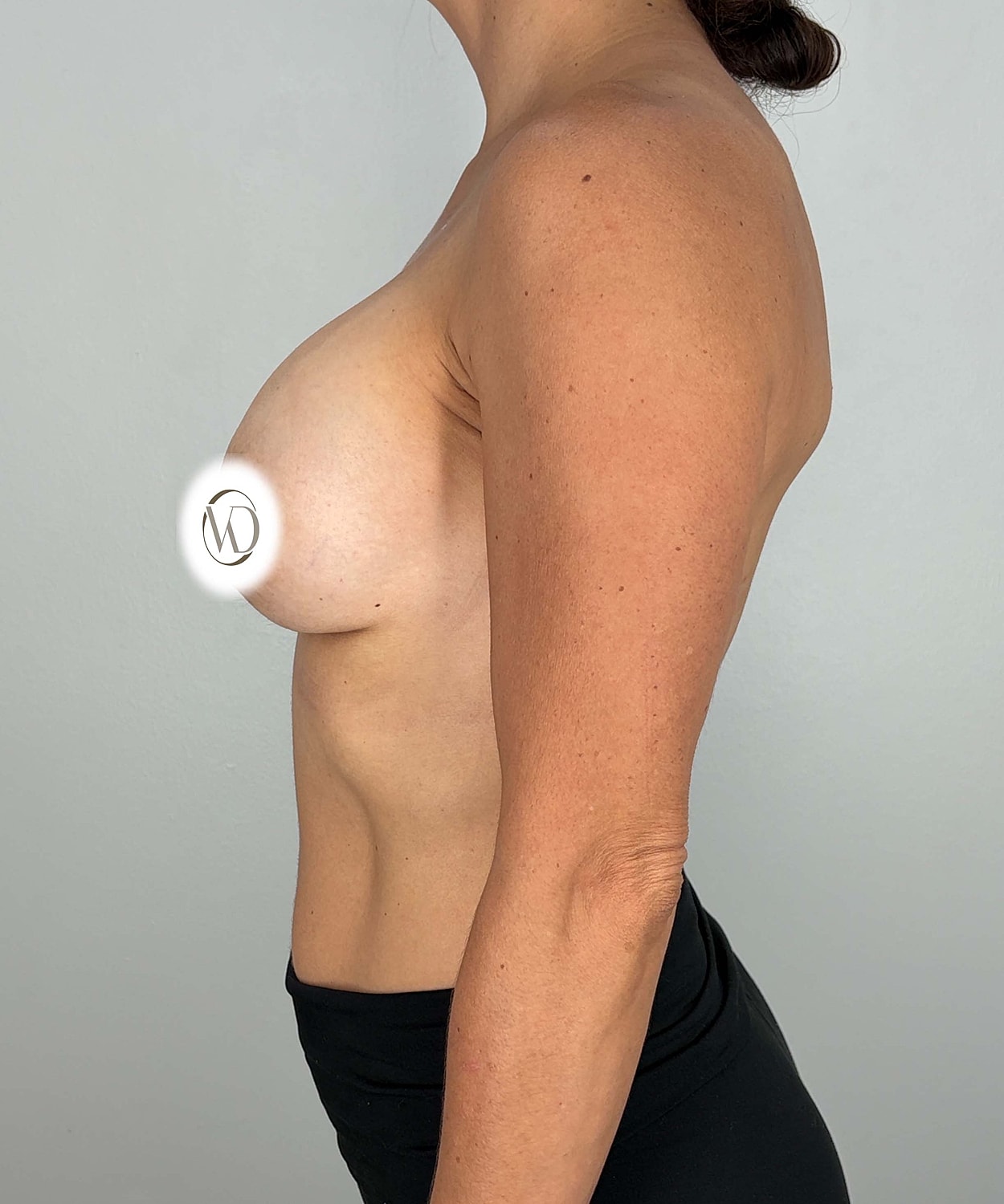 Breast Augmentation Gallery Before & After