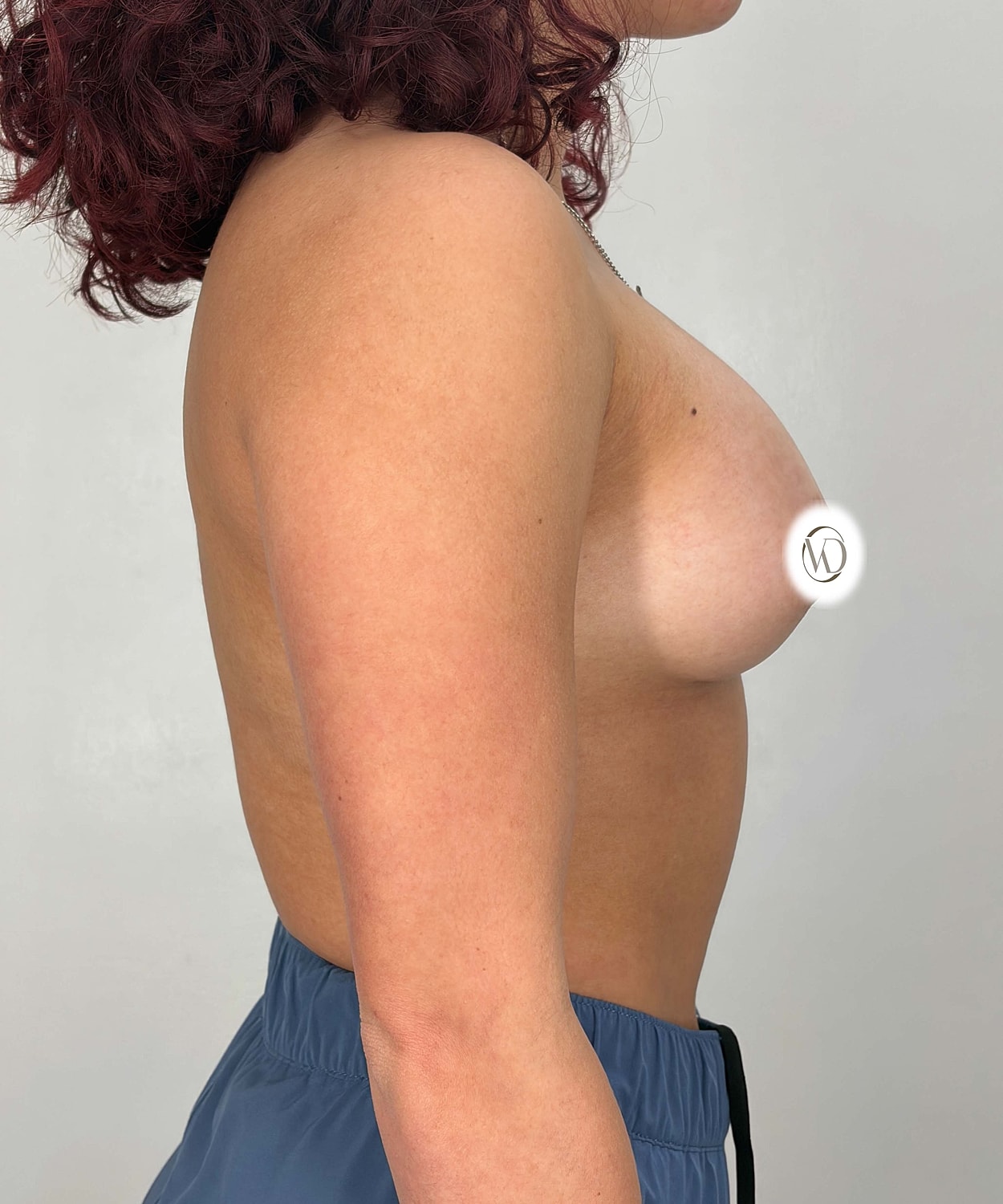 Breast Augmentation Gallery Before & After