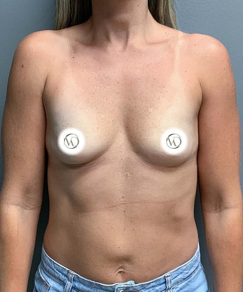 Breast Augmentation Before & After