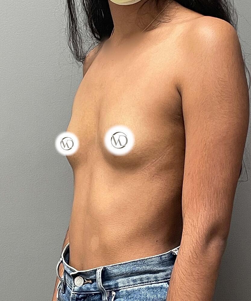 Breast Augmentation Before & After