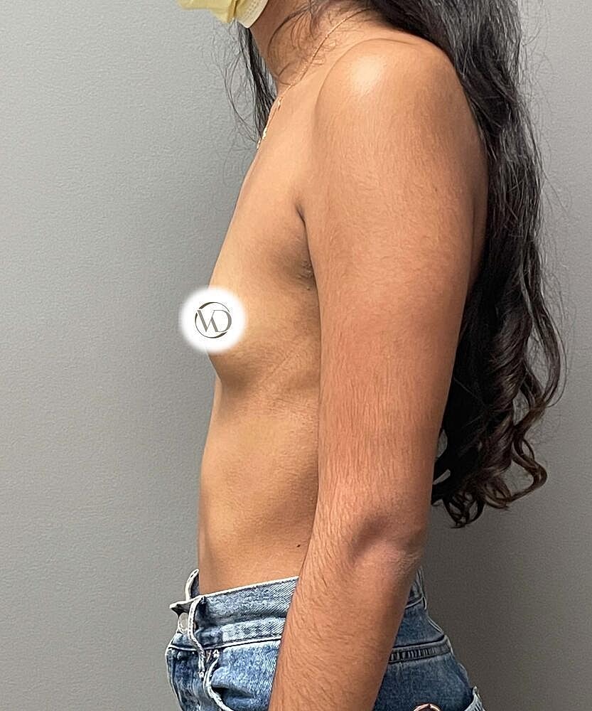 Breast Augmentation Before & After