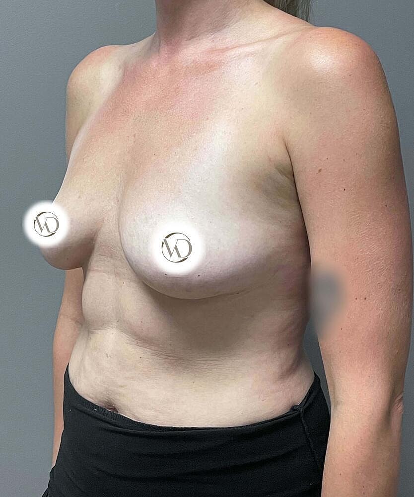 Breast Augmentation Before & After