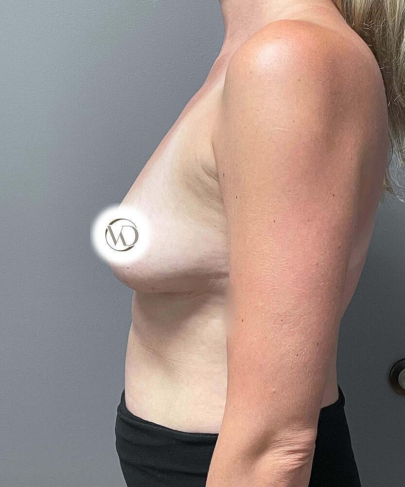 Breast Augmentation Before & After