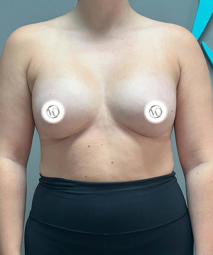 Breast Augmentation Before & After