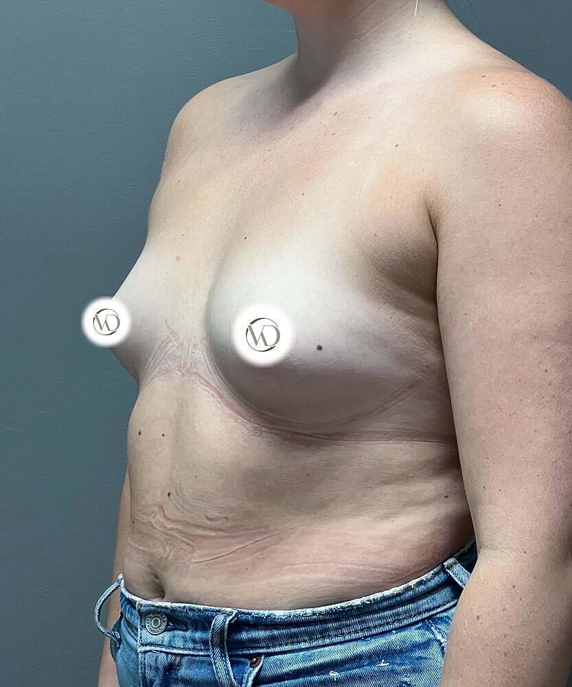 Breast Augmentation Before & After