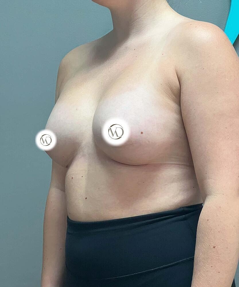 Breast Augmentation Before & After