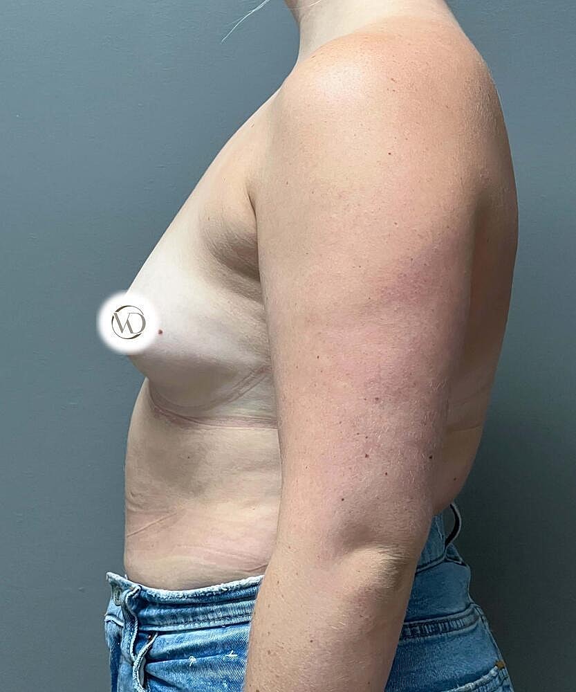 Breast Augmentation Before & After