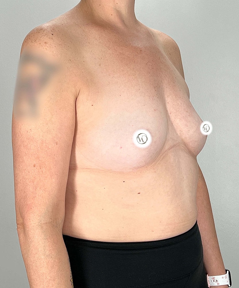 Breast Augmentation Before & After
