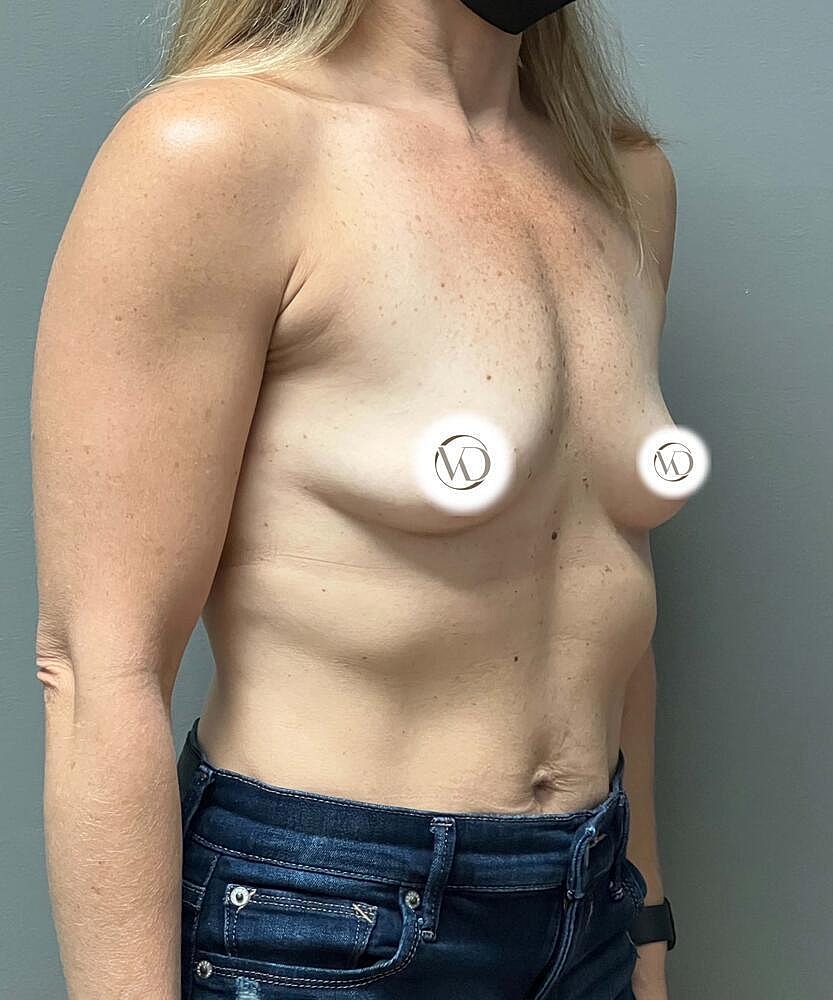 Breast Augmentation Before & After