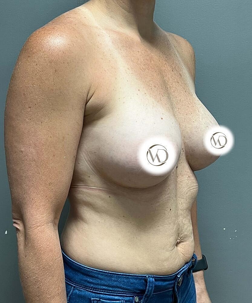Breast Augmentation Before & After