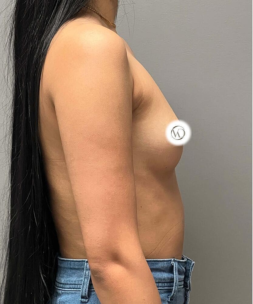 Breast Augmentation Before & After