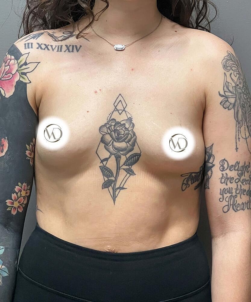 Breast Augmentation Before & After
