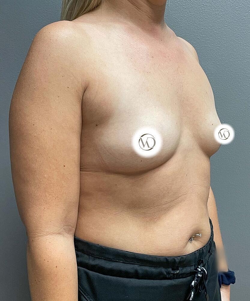 Breast Augmentation Before & After