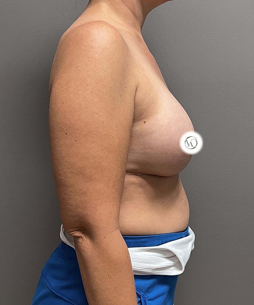 Breast Augmentation Before & After