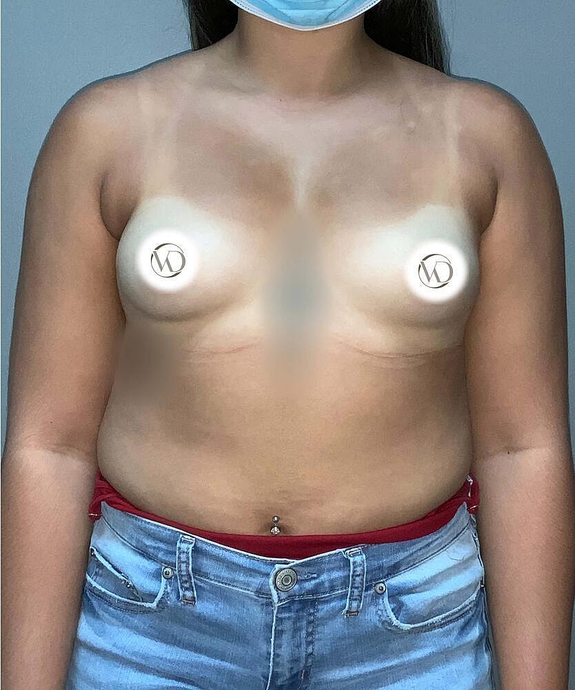 Breast Augmentation Before & After