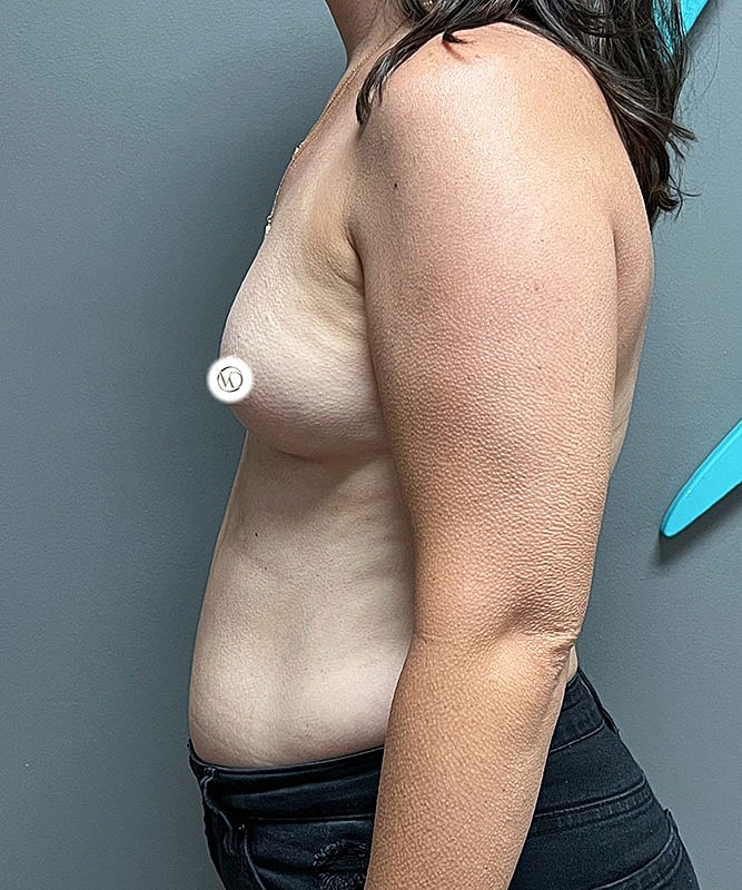 Breast Augmentation Before & After