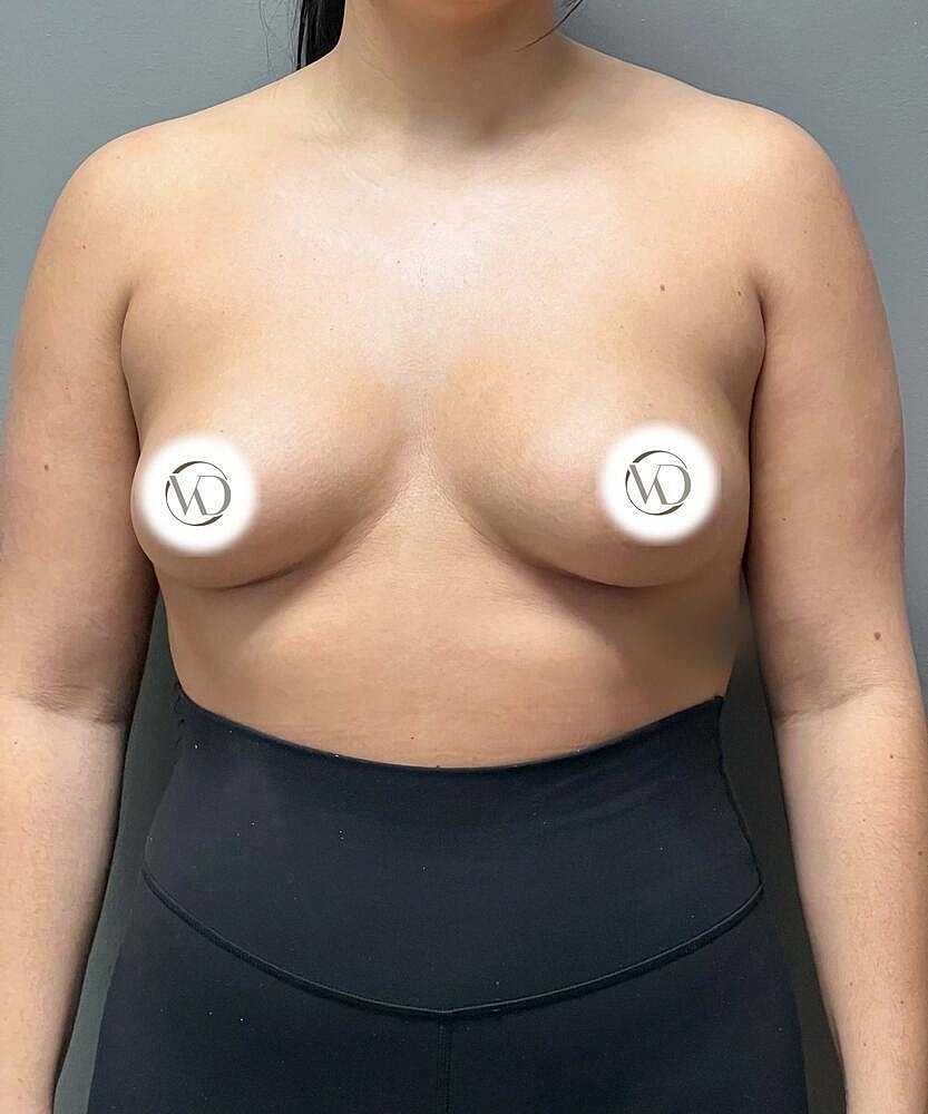 Breast Augmentation Before & After