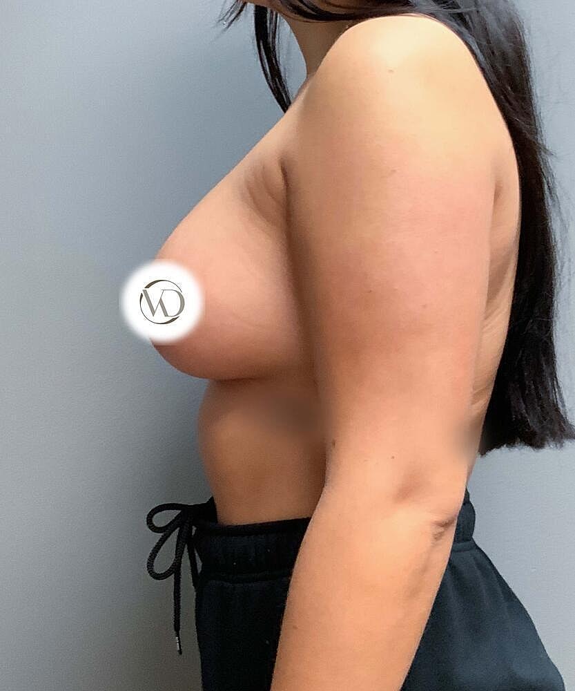 Breast Augmentation Before & After