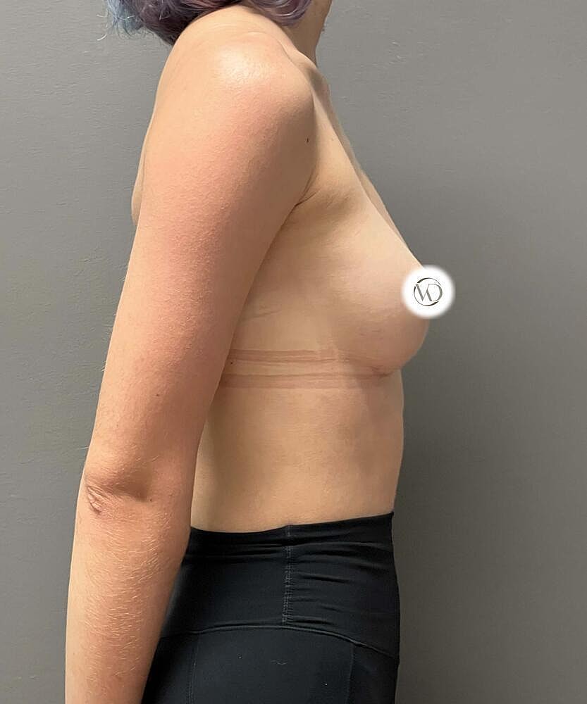 Breast Augmentation Before & After