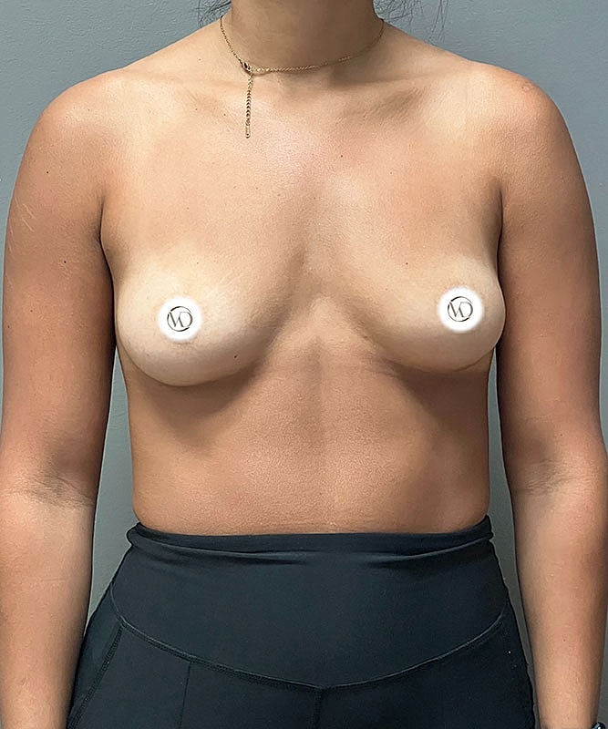 Breast Augmentation Before & After