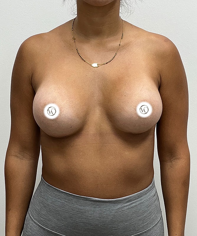 Breast Augmentation Before & After