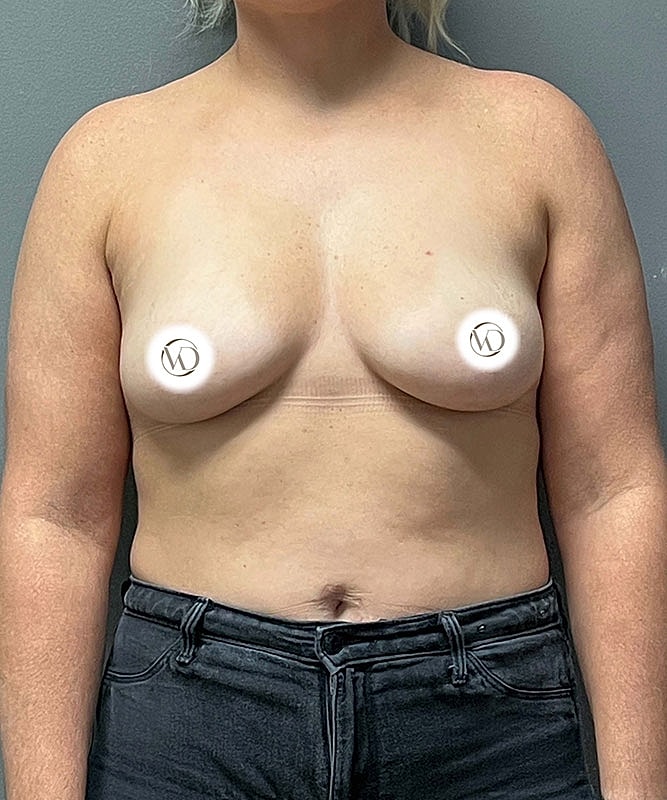 Breast Augmentation Before & After