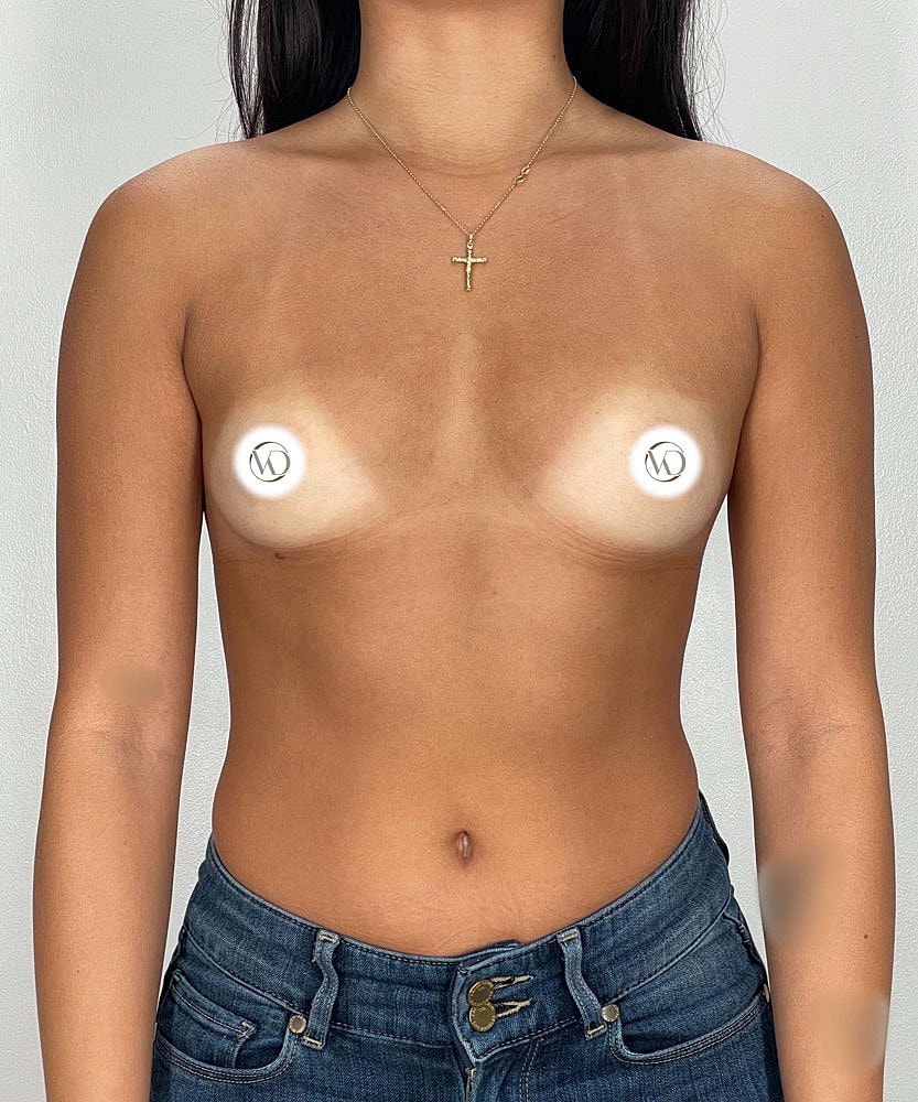 Breast Augmentation Before & After