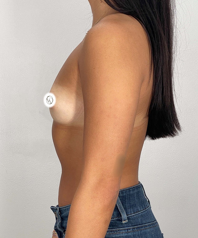 Breast Augmentation Before & After