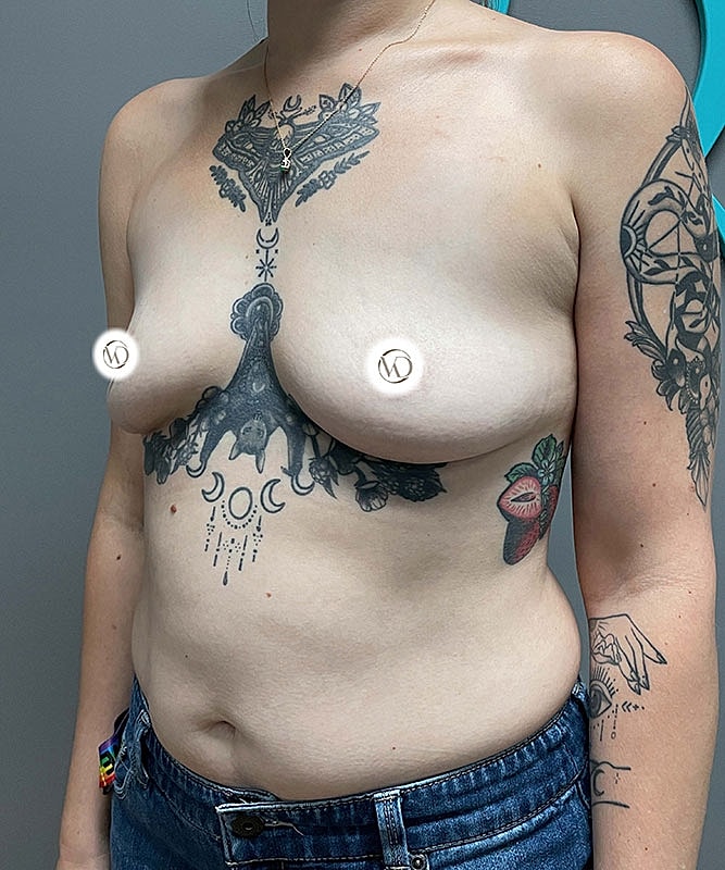 Breast Augmentation Before & After