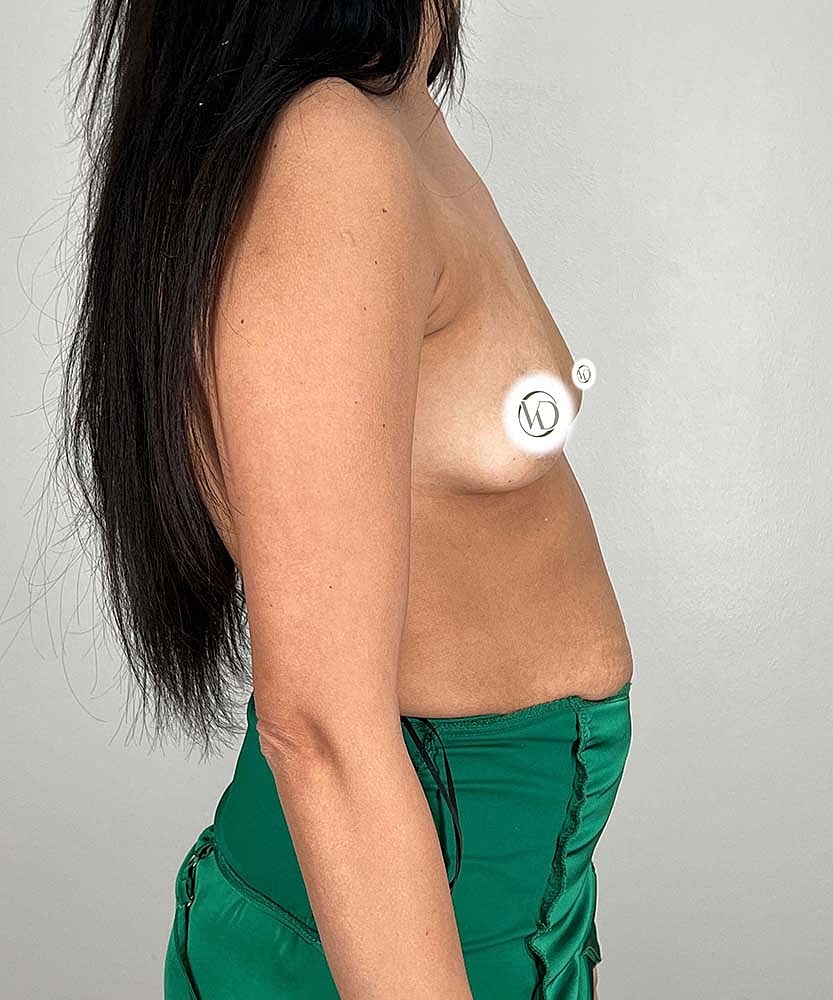 Breast Augmentation Before & After