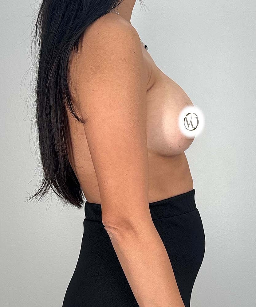 Breast Augmentation Before & After