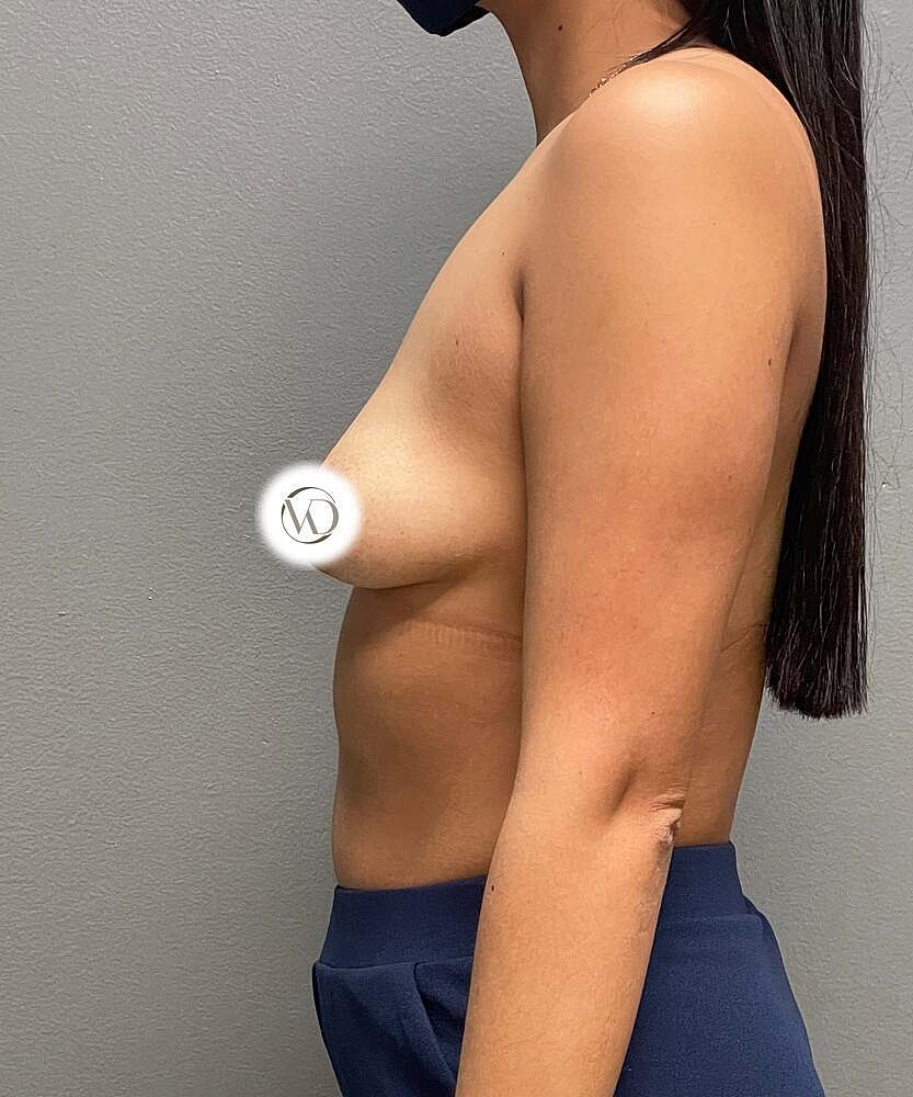 Breast Augmentation Before & After