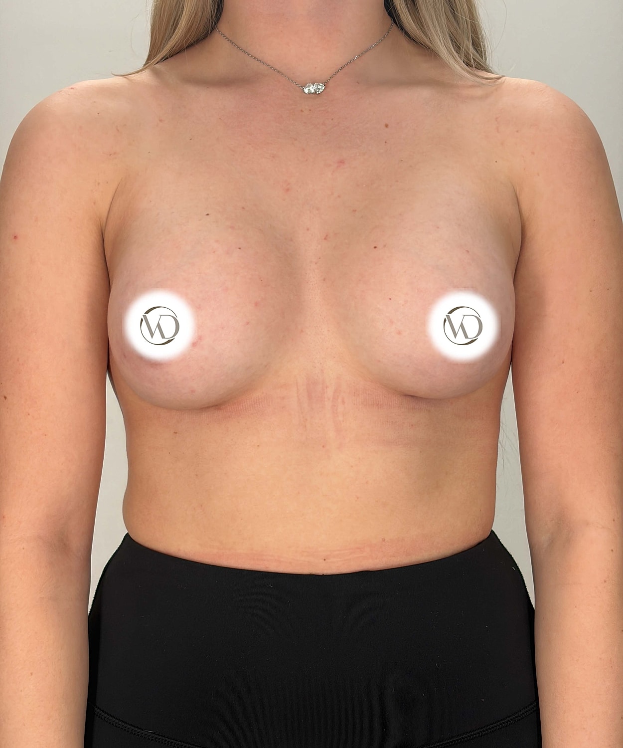 Breast Augmentation Gallery Before & After