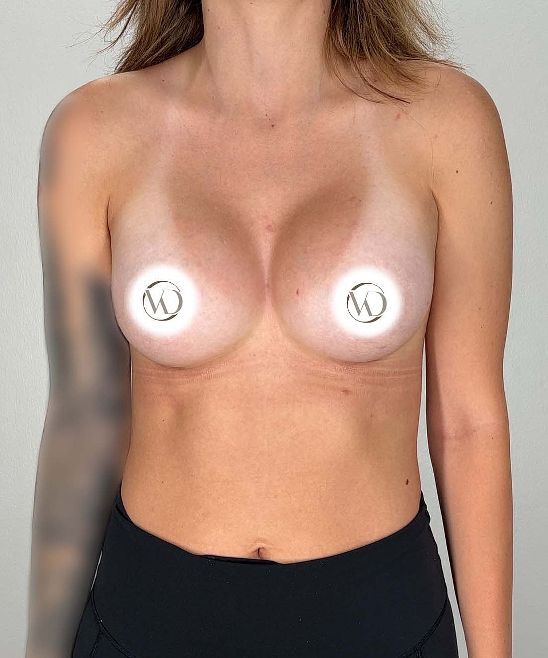 Breast Augmentation Gallery Before & After