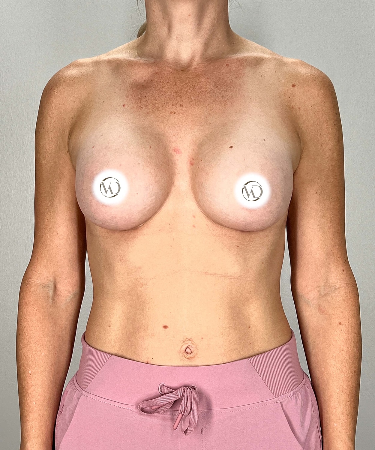 Breast Augmentation Gallery Before & After
