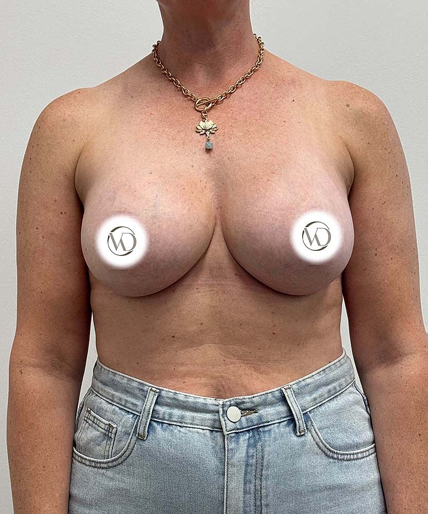 Breast Augmentation Before & After
