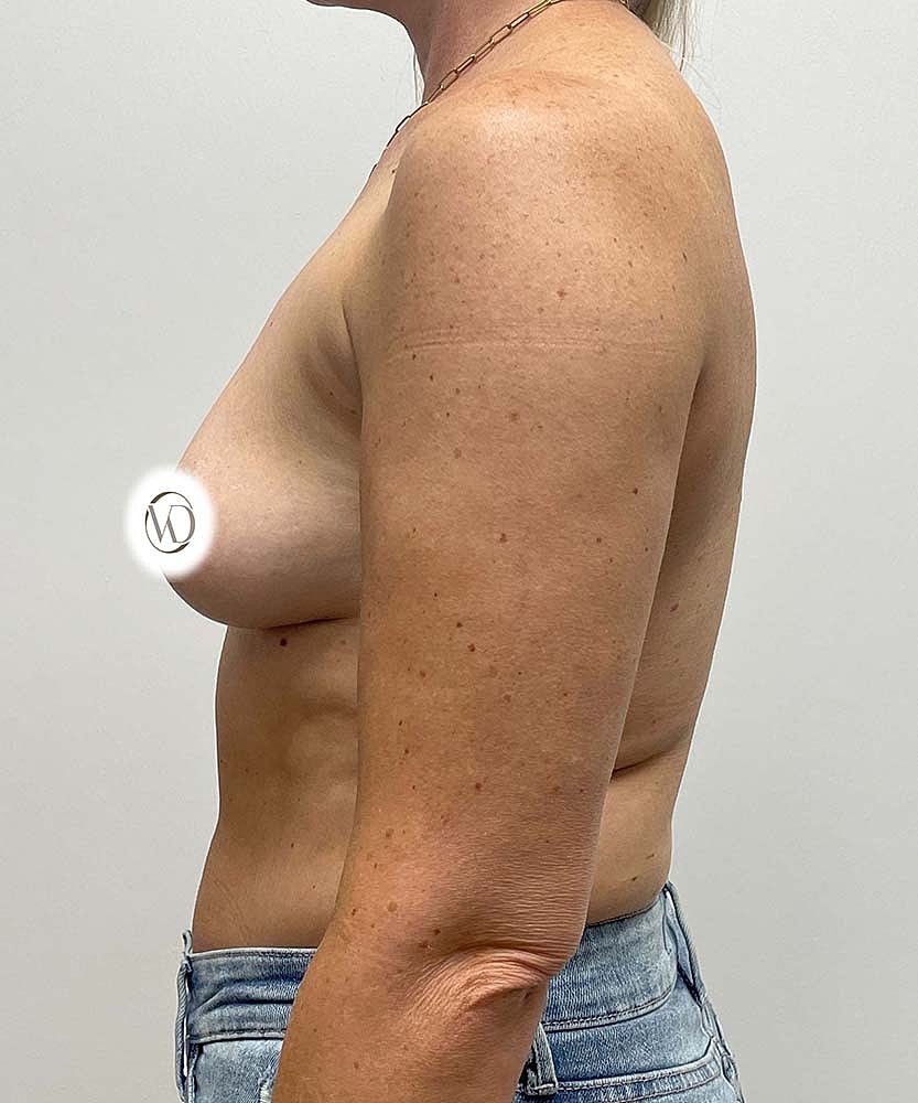 Breast Augmentation Before & After