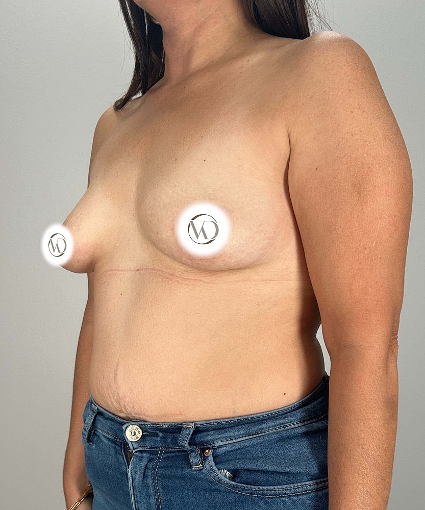 Breast Augmentation Before & After