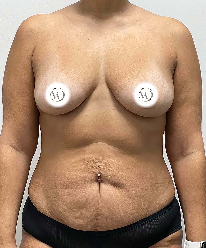 Breast Augmentation Before & After