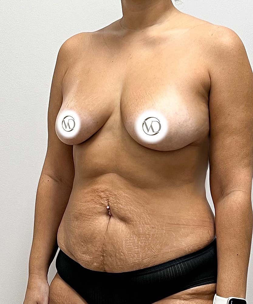 Breast Augmentation Before & After