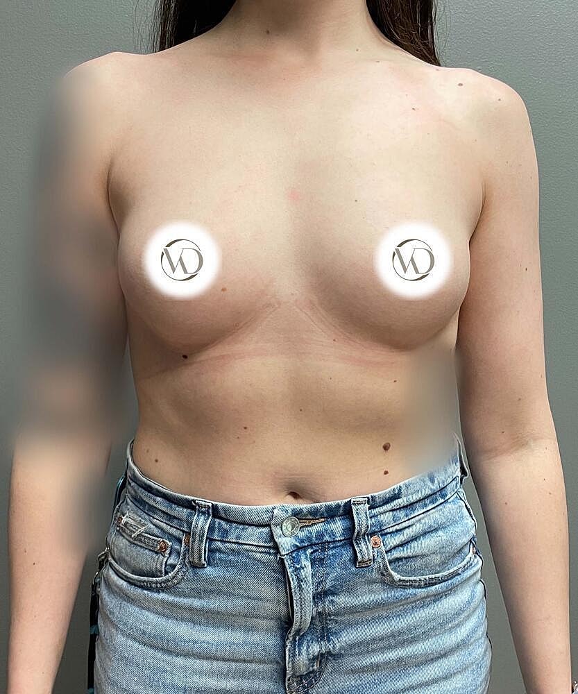 Breast Augmentation Before & After