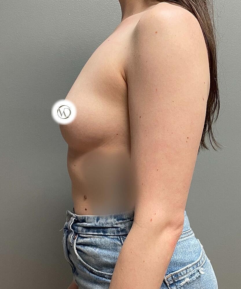 Breast Augmentation Before & After