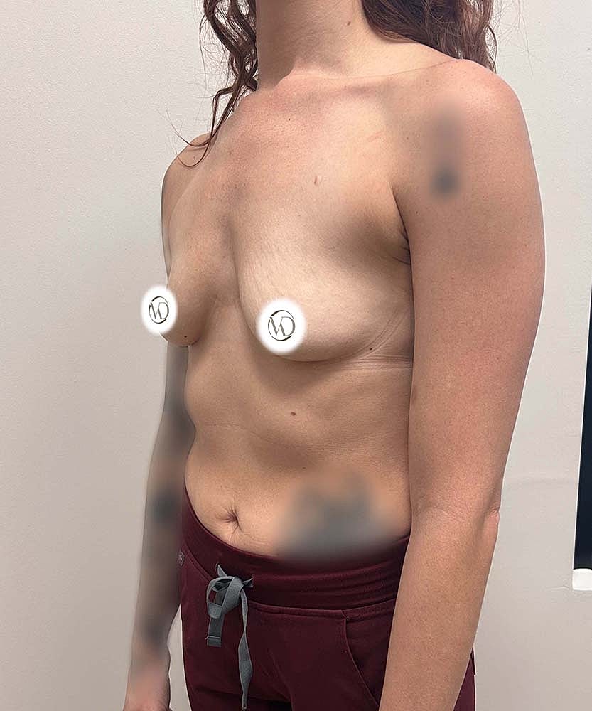 Breast Augmentation Before & After