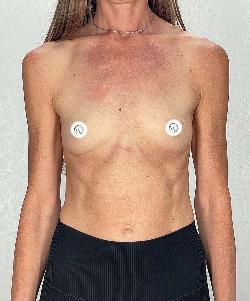 Breast Augmentation Before & After