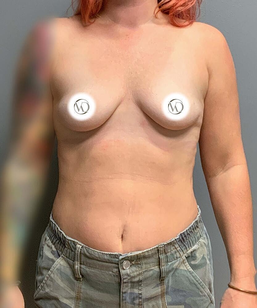 Breast Augmentation Before & After