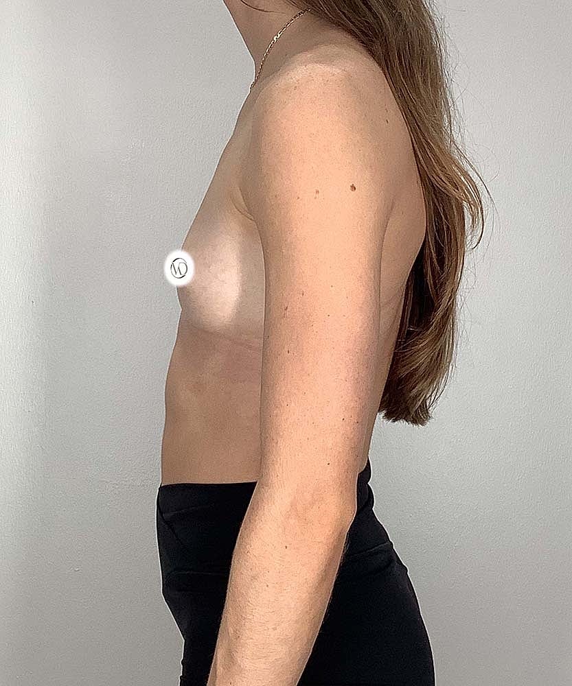 Breast Augmentation Before & After