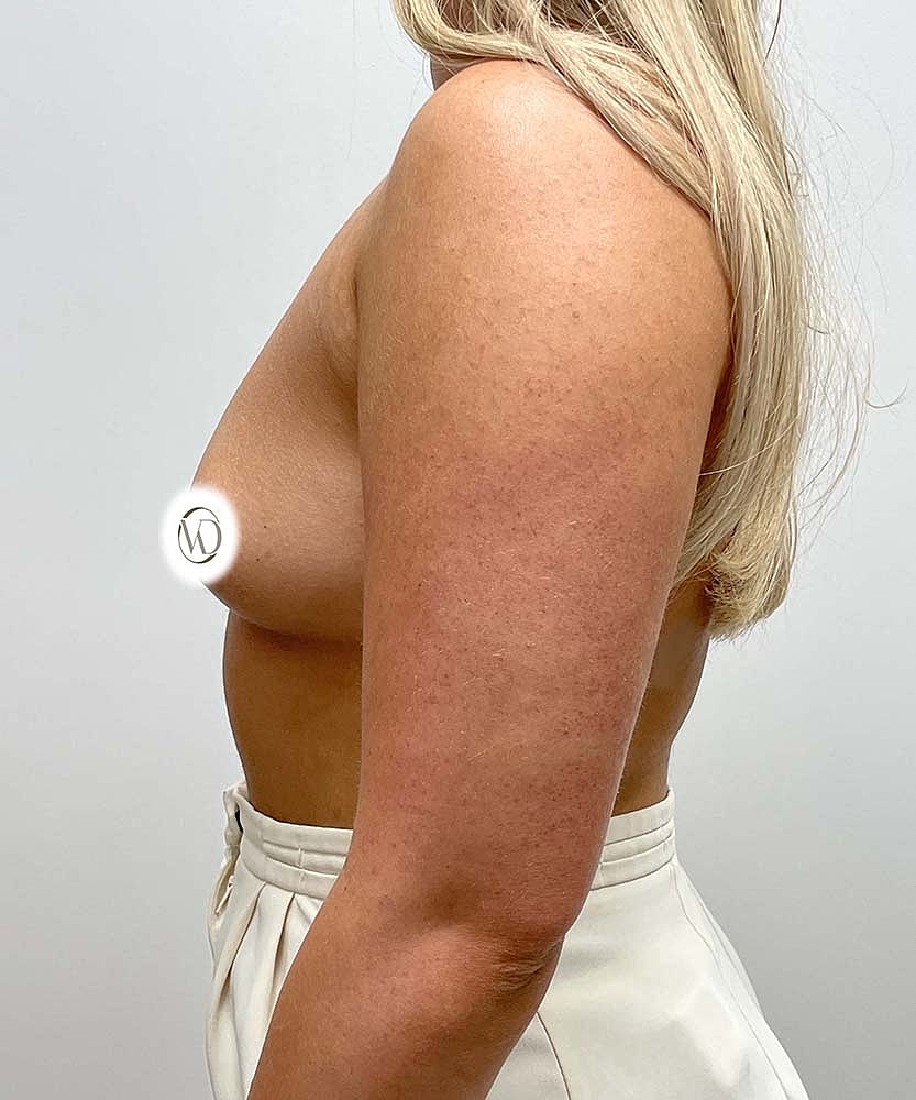 Breast Augmentation Before & After