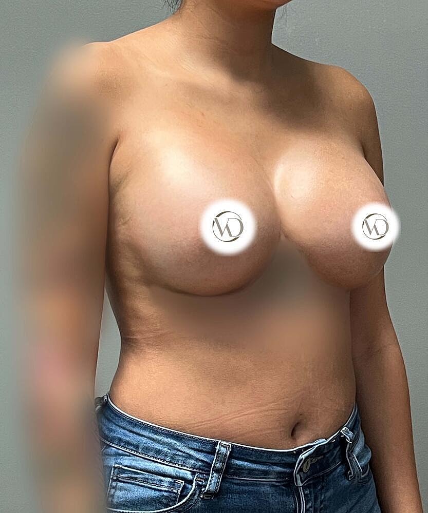 Breast Augmentation Before & After